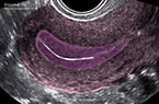 Endomètre de la phase proliférative pré-ovulatoire - Contractilité utérine - Follicule mâture