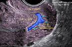 Endomètre de la phase proliférative pré-ovulatoire - Contractilité utérine ondulatoire - Follicule mâture