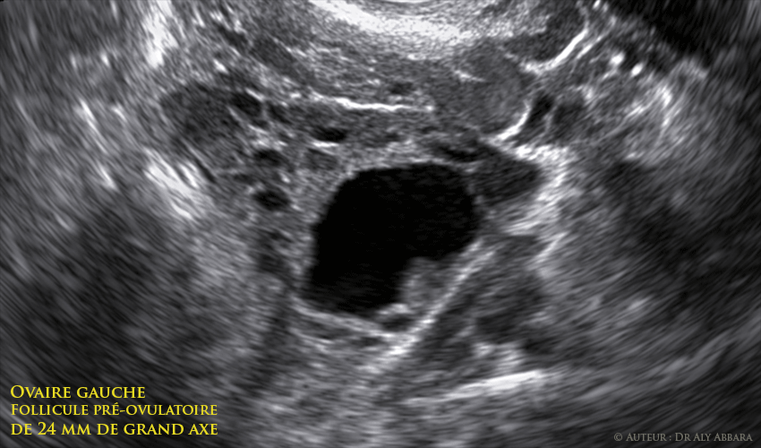 Ovaire gauche - follicule de Gaaf mature