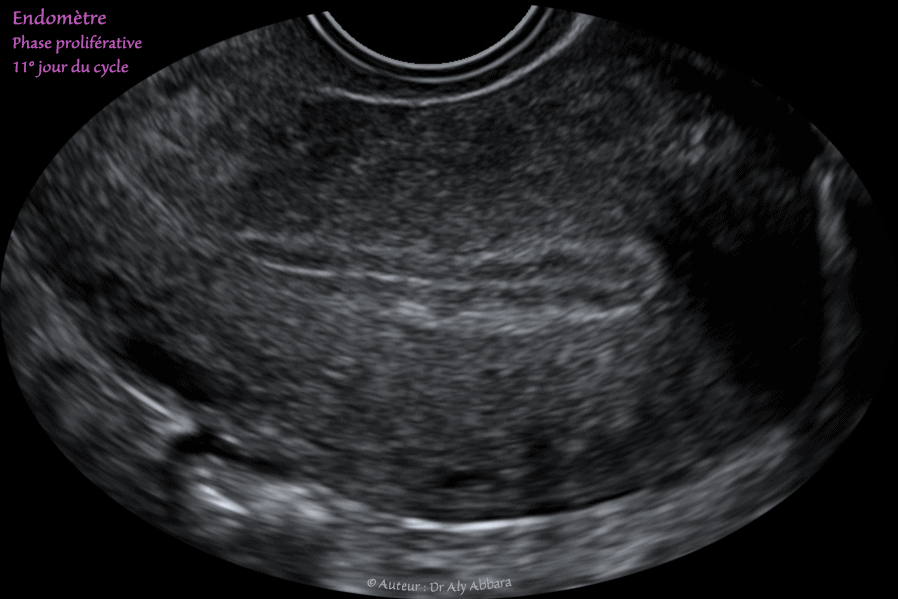 DIU au cuivre : déplacemet vers le canal endocervical sous l'effect des contractions utérines