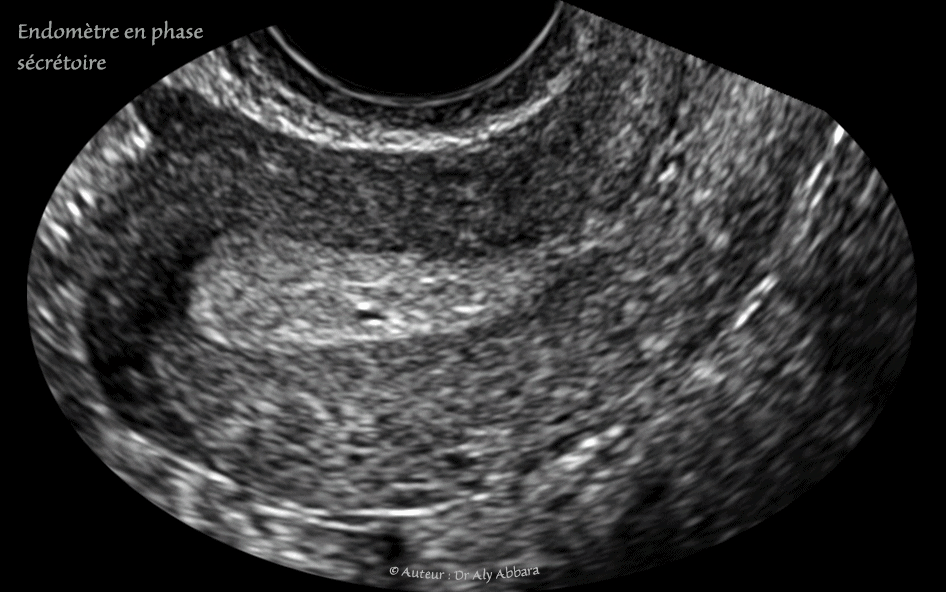 DIU au cuivre : déplacemet vers le canal endocervical sous l'effect des contractions utérines