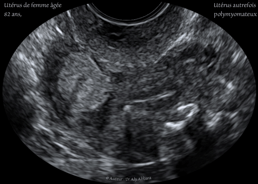 Utérus - femme de 82 ans - atrophie de l'endomètre - myomes involués - رحم إمرأة مسنة - ضمور بطانة الرحم - أورام ليفية ضامرة