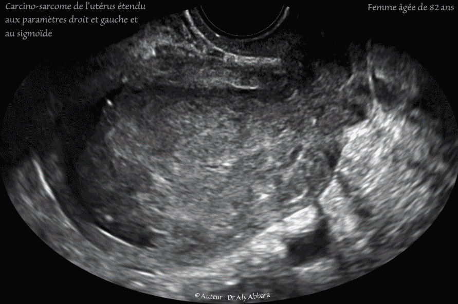 Utérus - femme de 82 ans - atrophie de l'endomètre - myomes involués - رحم إمرأة مسنة - ضمور بطانة الرحم - أورام ليفية ضامرة