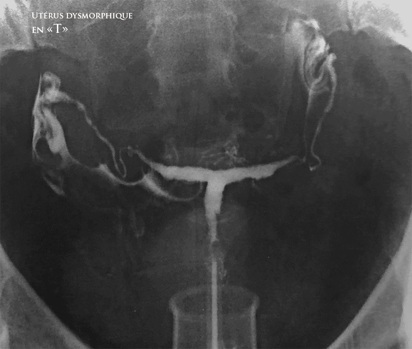 Perforation utérine lors d'une IVG chirurgicale sur utérus malformé, bichorne et bicicatriciel (antcédent de 2 césariennes)