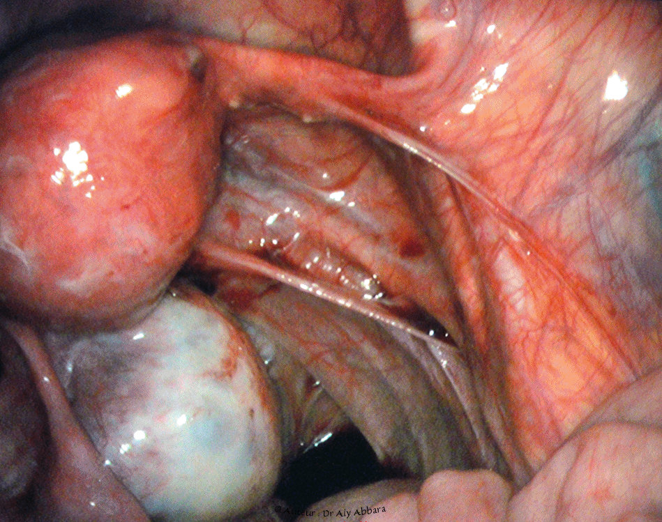 Image clinique coelioscopique montrant le reflux rétrograde, utéro-tubo-abdominal de sang menstrul (règles rétrograde)