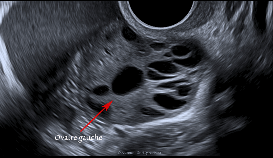 Image clinique échographique du petit pelvis et de l'ovaire gauche montrant le reflux rétrograde, tubo-abdominal de sang menstrul (sang des règles)