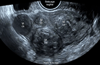 Utérus plymyomateux comportant 9 myomes de classes différentes de FIGO 2011