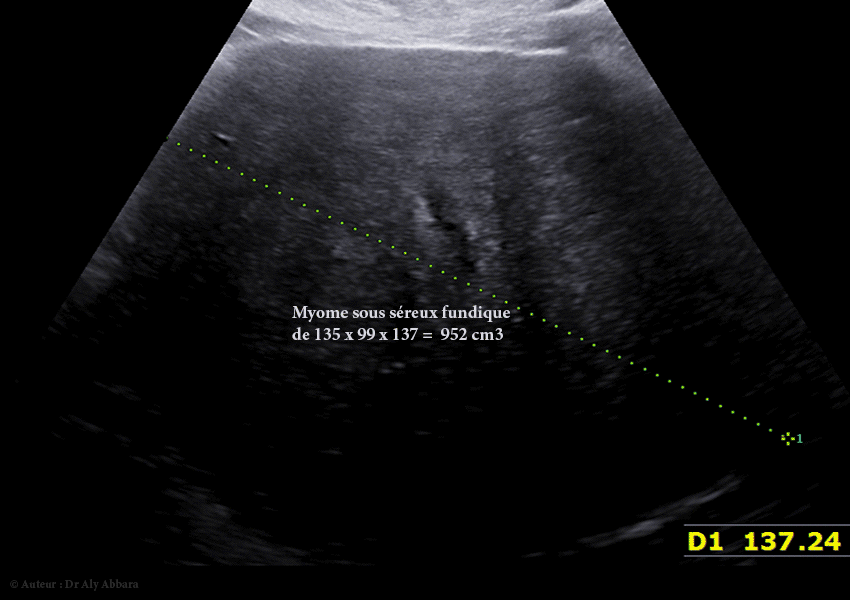 Grossesse intra-utérine évolutive de 12 SA sous DIU (stérilet) au cuivre - Échec de l'effet contraceptif