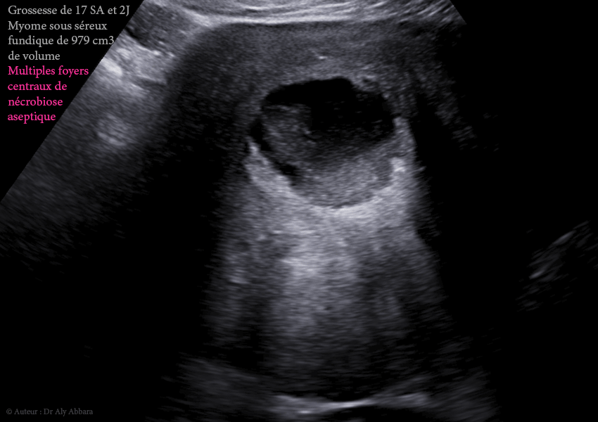 Grossesse intra-utérine évolutive de 12 SA sous DIU (stérilet) au cuivre - Échec de l'effet contraceptif