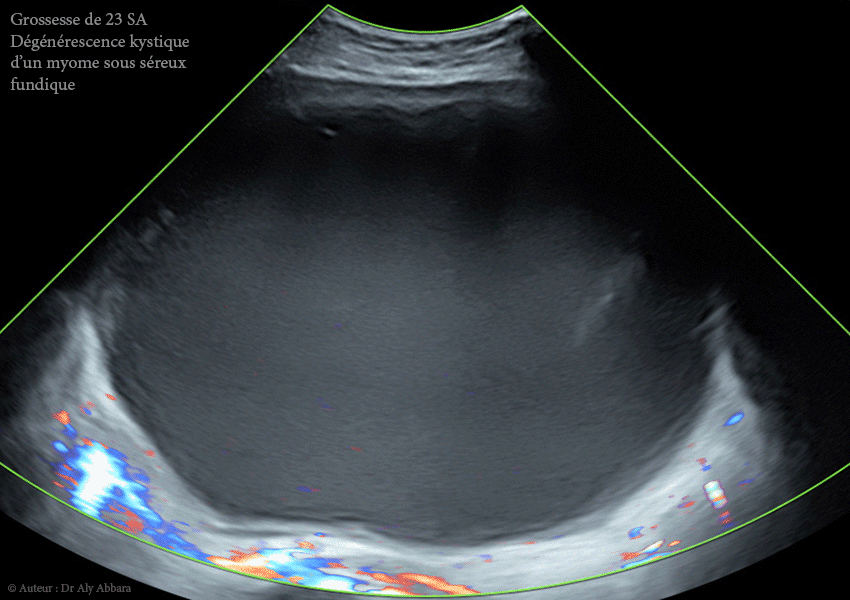 Grossesse intra-utérine évolutive de 12 SA sous DIU (stérilet) au cuivre - Échec de l'effet contraceptif