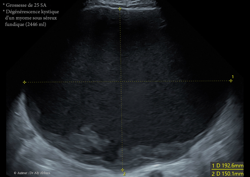 Grossesse intra-utérine évolutive de 12 SA sous DIU (stérilet) au cuivre - Échec de l'effet contraceptif