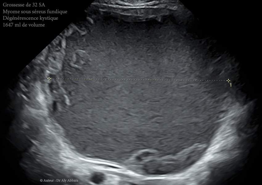 Grossesse intra-utérine évolutive de 12 SA sous DIU (stérilet) au cuivre - Échec de l'effet contraceptif