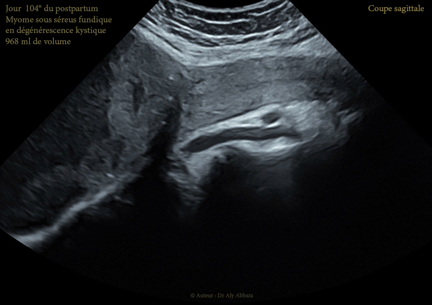 Grossesse intra-utérine évolutive de 12 SA sous DIU (stérilet) au cuivre - Échec de l'effet contraceptif