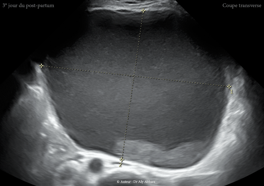 Grossesse intra-utérine évolutive de 12 SA sous DIU (stérilet) au cuivre - Échec de l'effet contraceptif