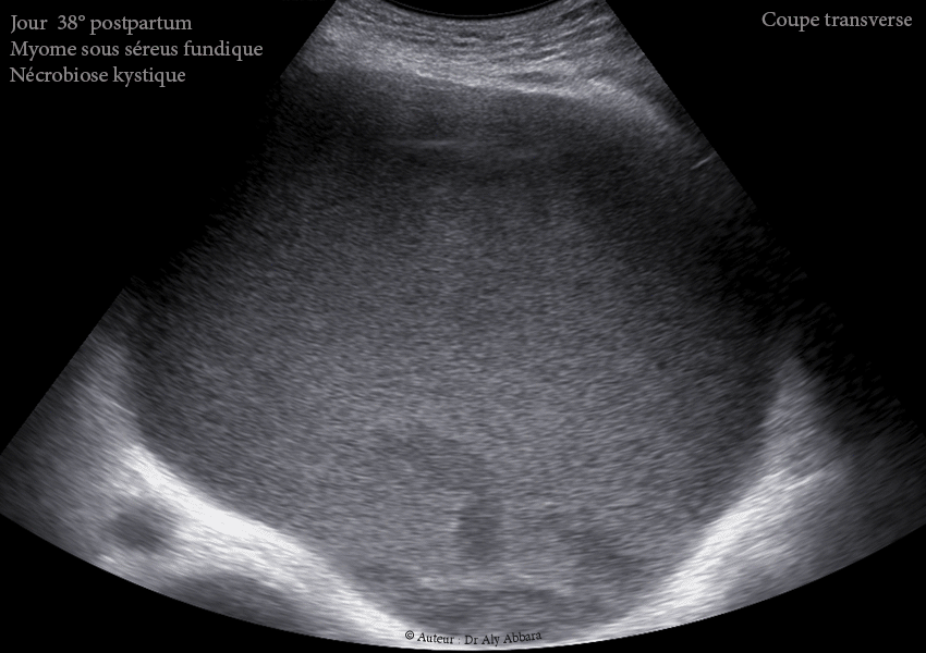Grossesse intra-utérine évolutive de 12 SA sous DIU (stérilet) au cuivre - Échec de l'effet contraceptif