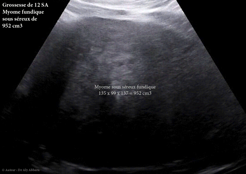 Autodiaporama montrant l'évolution du myome sous séreux fundique de la 12 SA jusqu'à la 14ème semaines post-myomectomie
