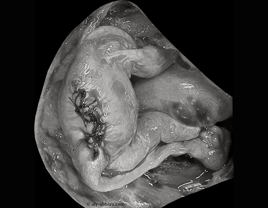 Grossesse intra-utérine évolutive de 12 SA sous DIU (stérilet) au cuivre - Échec de l'effet contraceptif