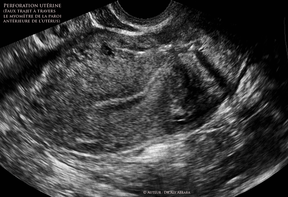 Perforation utérine lors d'une IVG chirurgicale sur utérus malformé, bichorne et bicicatriciel (antcédent de 2 césariennes)