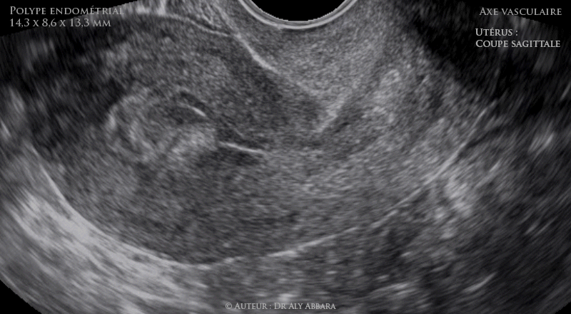 Polype endométrial avec son axe vasculaire qui permet d'identifier son point d'insertion sur l'endomètre