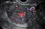 Polype endométrial avec son axe vasculaire qui permet d'identifier son point d'insertion sur l'endomètre