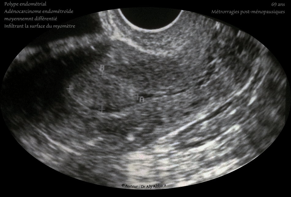 Utérus - Polype endométrial - Adénocarcinome endométroïde - Échographie
