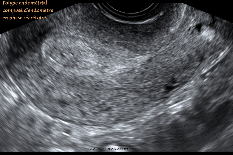 Polype endométrial sécrétoire