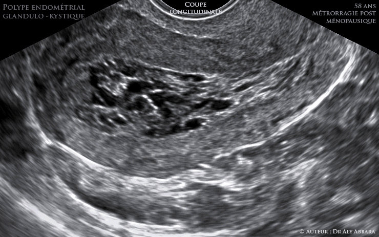 DIU au cuivre : déplacemet vers le canal endocervical sous l'effect des contractions utérines