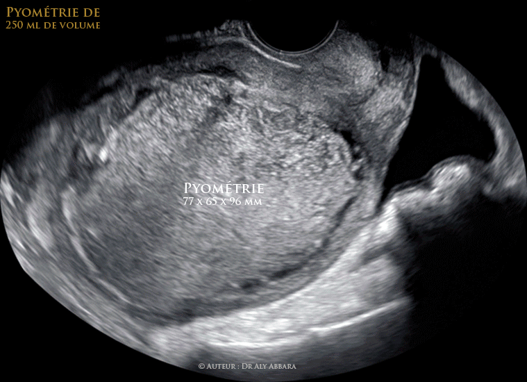 Utérus : volumineuse pyométrie de 250 ml de volume