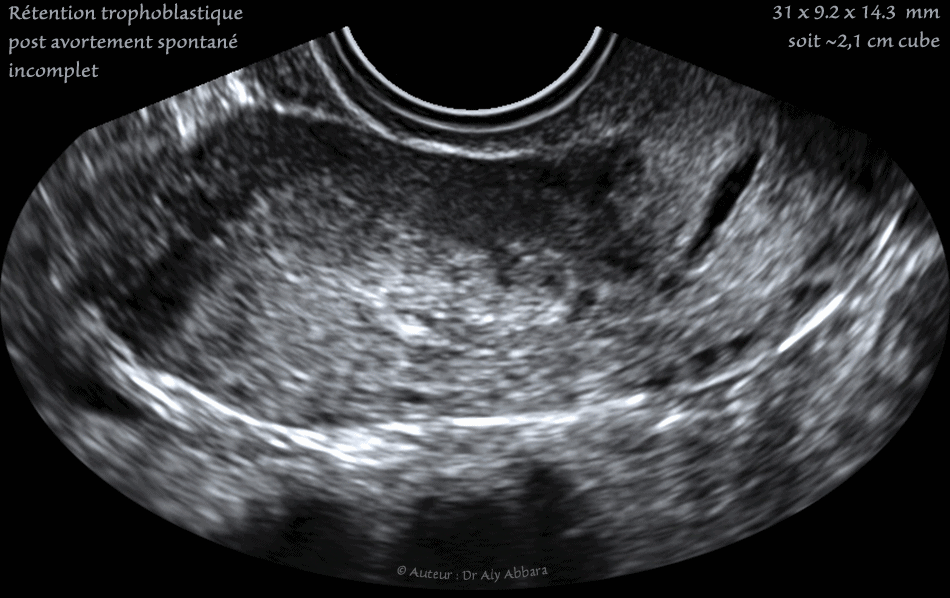 Avortement incomplet d'un oeuf clair (rétention trophoblastique)