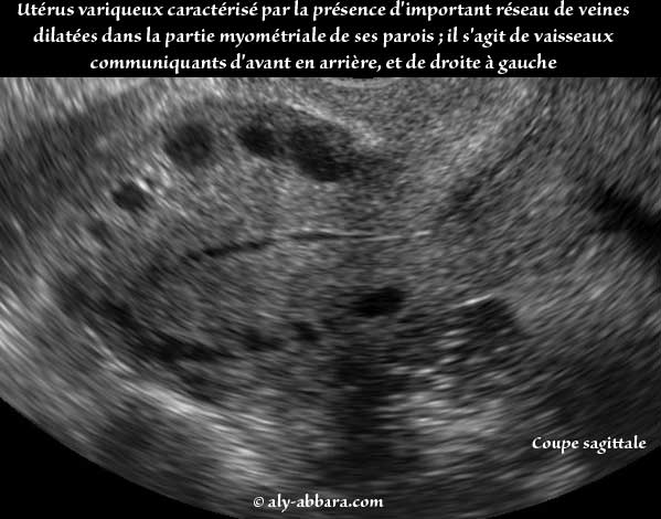 varice uterine