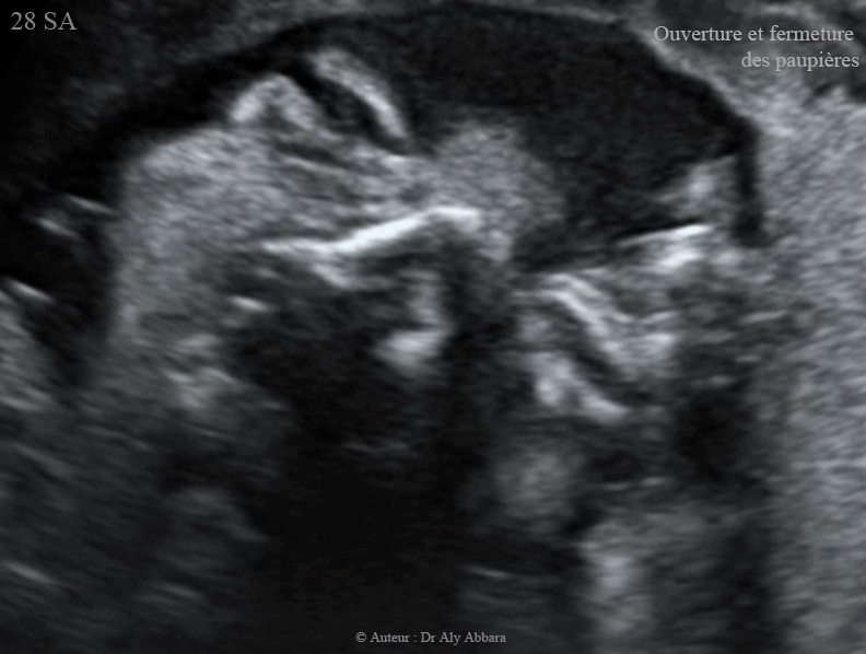 Mouvements d'ouverture - fermeture des paupières - foetus de 28 SA - حركات فتح وإغلاق الأجفان عند الجنين بعمر 28 أسبوع