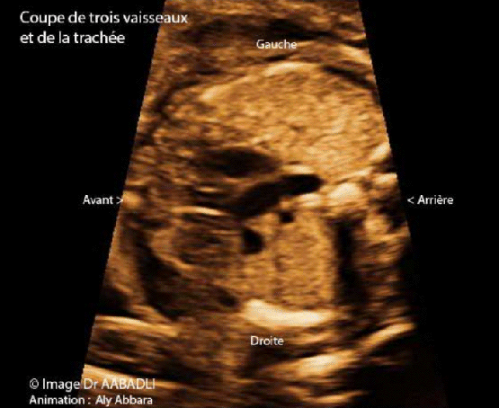 (La coupe de trois vaisseaux et la trachée)