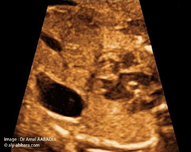 Le Diaphragme foetal - image 01