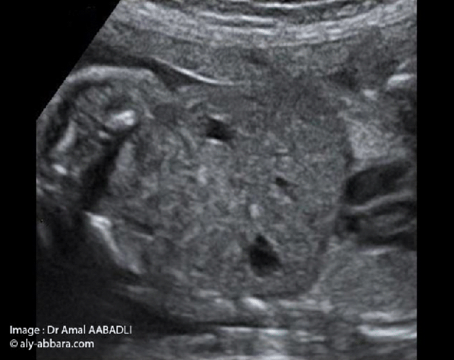 Le Diaphragme foetal - image 03