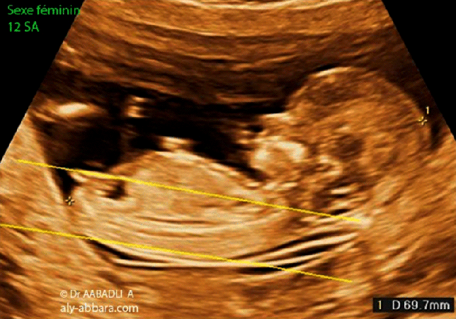 Foetus du sexe féminin à 12 SA