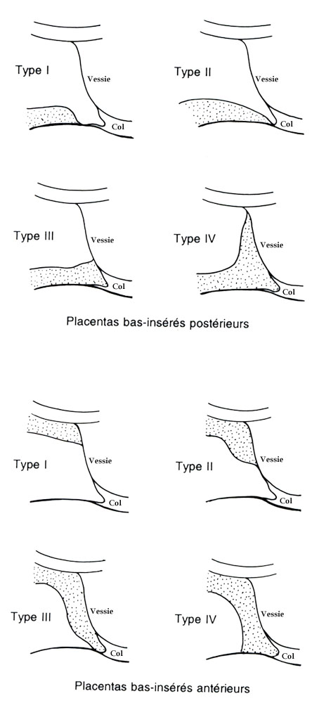 Classification anatomique et echographique des placentas praevias