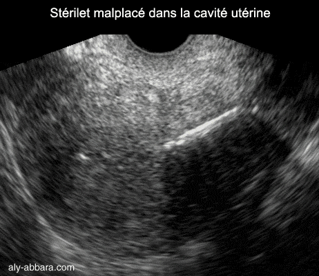 Stérilet au cuivre déplacé vers la zone isthmique de l'utérus