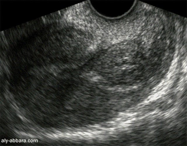 Rétention trophoblastique post-IVG médicamenteuse