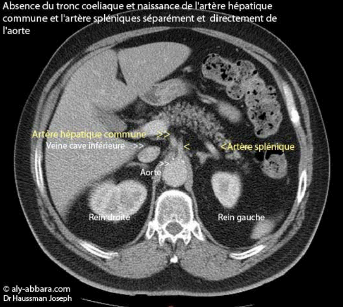 Image montrant l'absence du tronc coeliaque et la naissance de l'artère hépatique commune et l'artère splénique directement et séparément de l'aorte