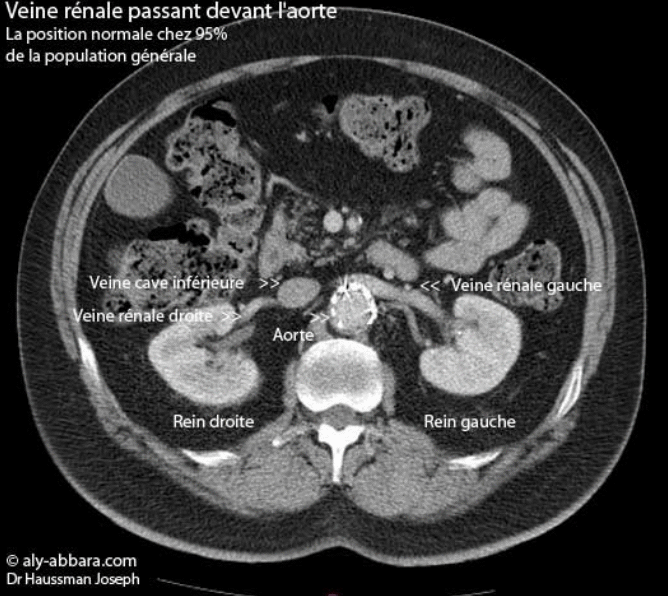 Veine rénale gauche en position antéro-aortique