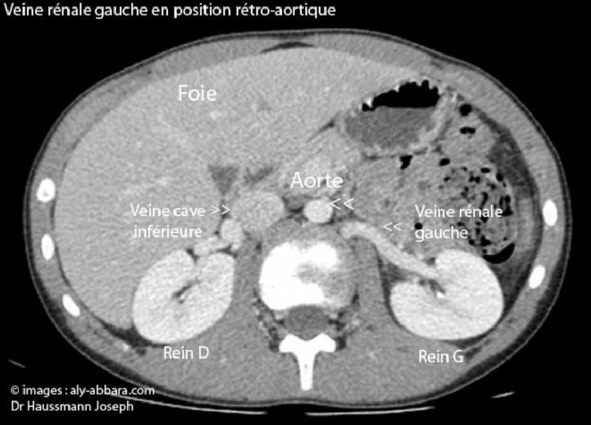Veine rénale gauche en position rétro-aortique