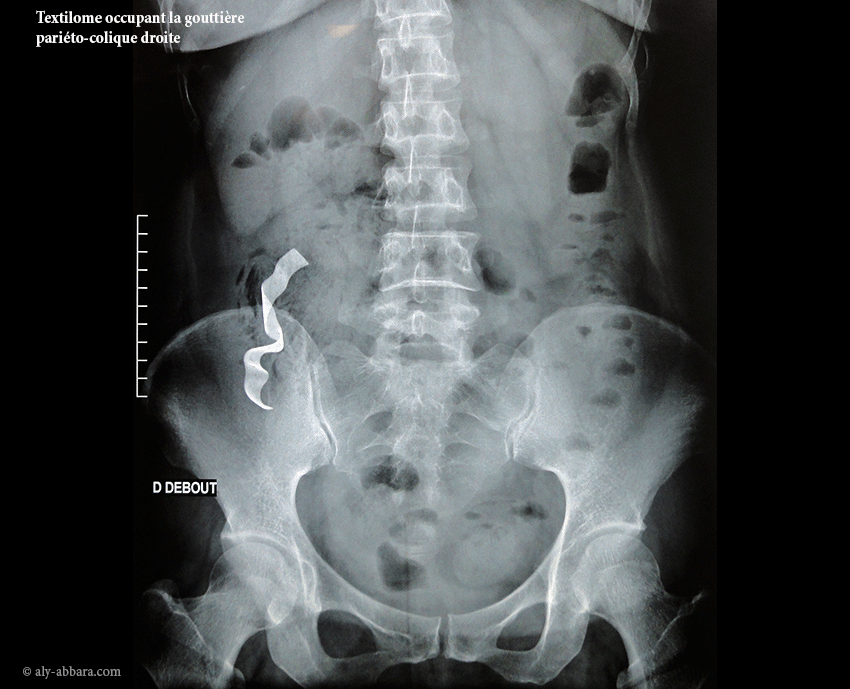 La mise en évidence de la bande radio-opaque du dispositif médical chirurgical