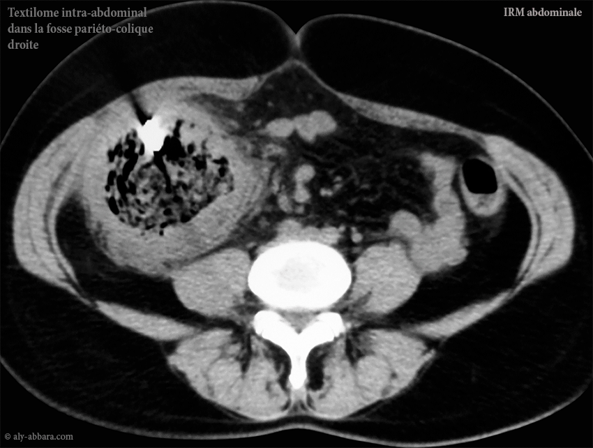 L'aspect par IRM du textilome dans la gouttière pariéto-colique droite