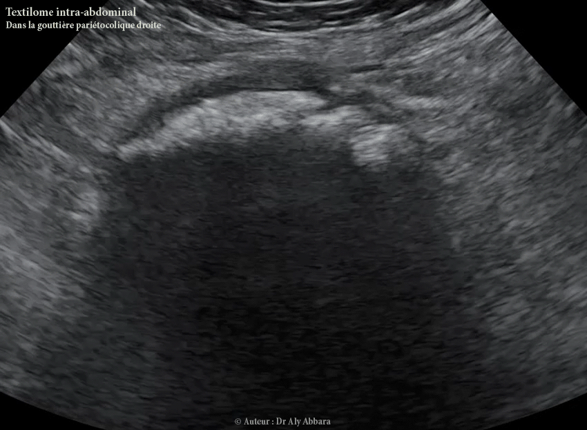 Grossesse triple évolutive tri-choriale tri-amniotique de 5 SA