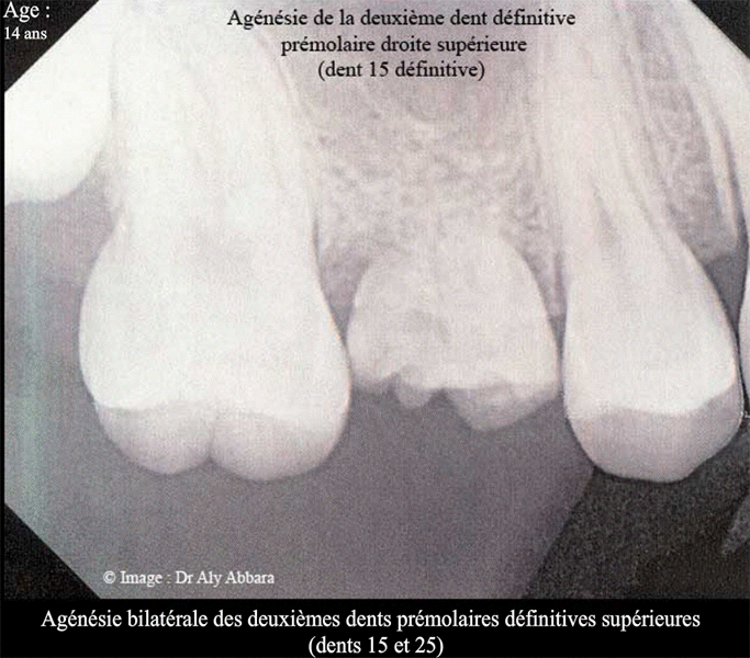 Agénésies dentaires chez une fille de 14 ans