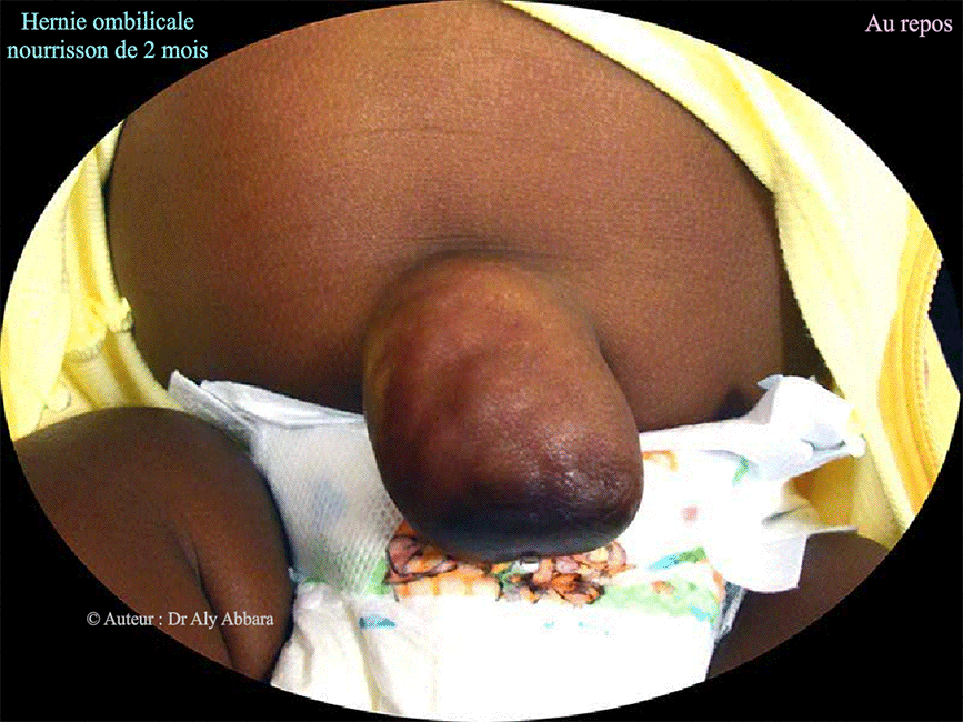Hernie ombilicale chez un nouveau né