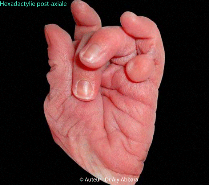 Polydactylie (hexadactylie) - Présence d'un doigt surnuméraire rudimentaire - Image clinique