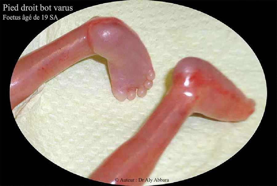 Pied bot varus - Foetus de 19 SA - Trisomie 18