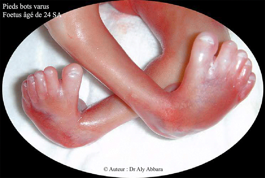 Pieds bots varus et talus (bilatéraux) - Images cliniques