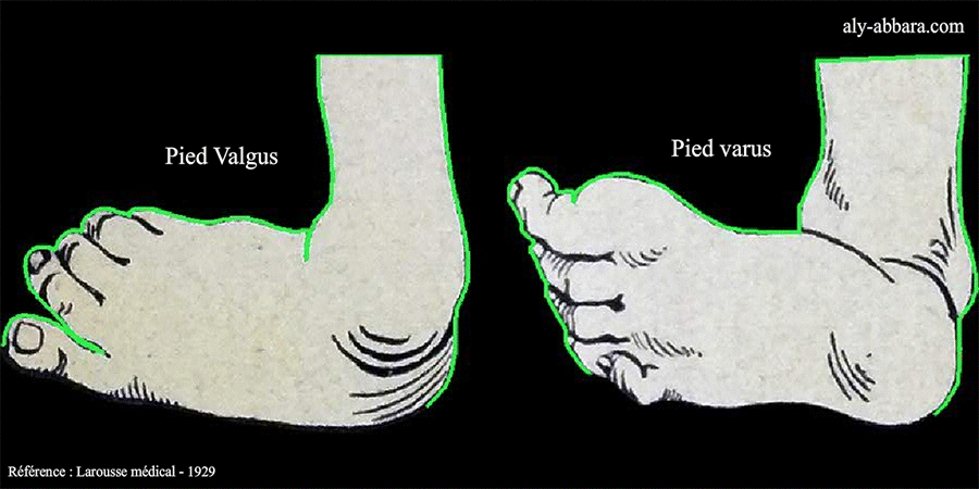 Pieds bots vangus et varus